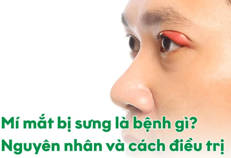 sưng mí mắt