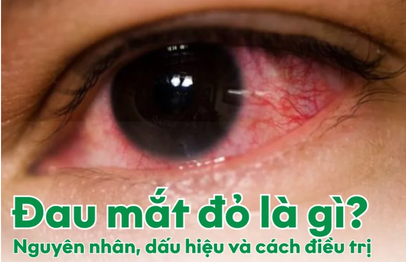 đau mắt đỏ