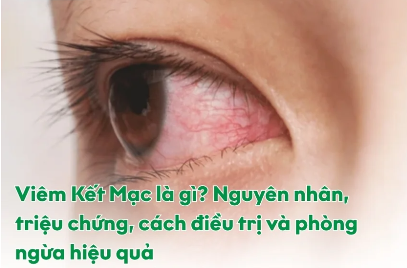 viêm kết mạc