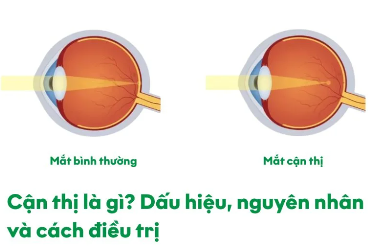 cận thị