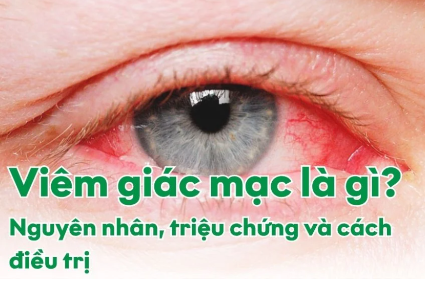 viêm giác mạc