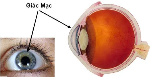 giác mạc mỏng 
