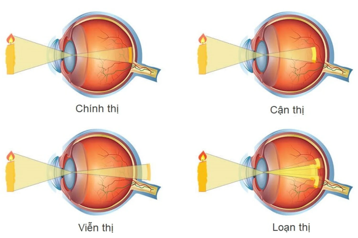 bệnh về mắt