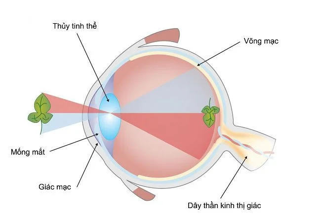 Viêm loét giác mạc 